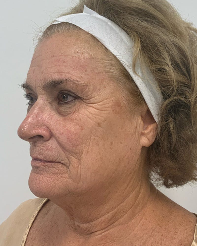 CO2 Laser Before & After Gallery - Patient 357136 - Image 3