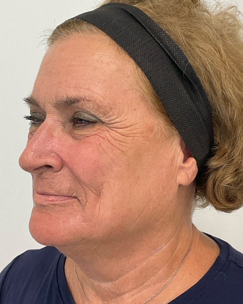 CO2 Laser Before & After Gallery - Patient 357136 - Image 4