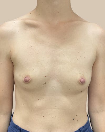 Breast Augmentation Before & After Gallery - Patient 746569 - Image 1