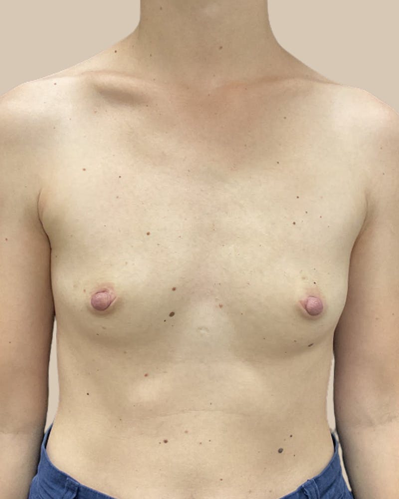 Breast Augmentation Before & After Gallery - Patient 746569 - Image 1