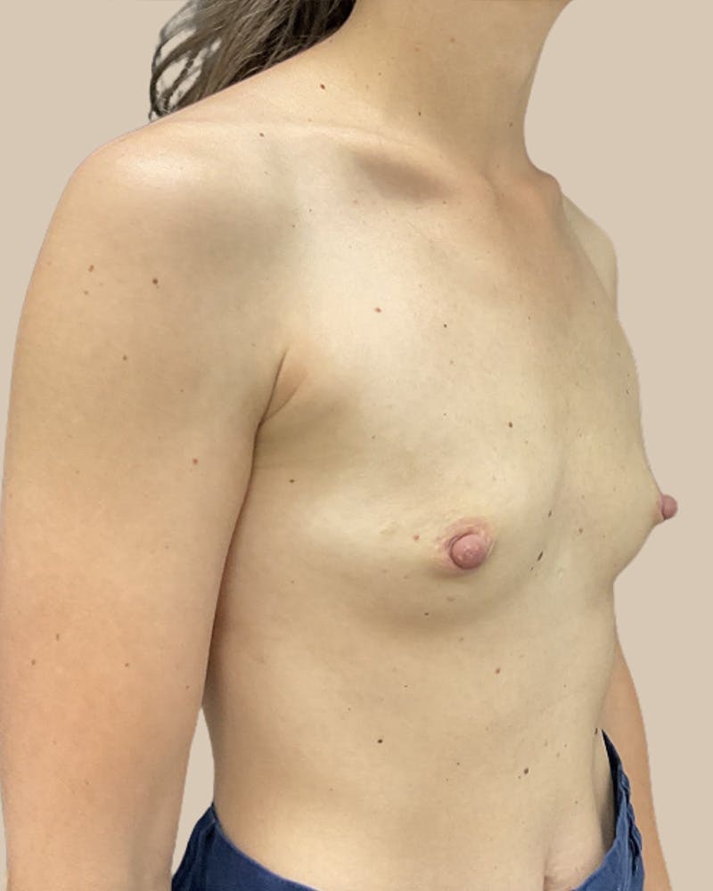 Breast Augmentation Before & After Gallery - Patient 746569 - Image 3