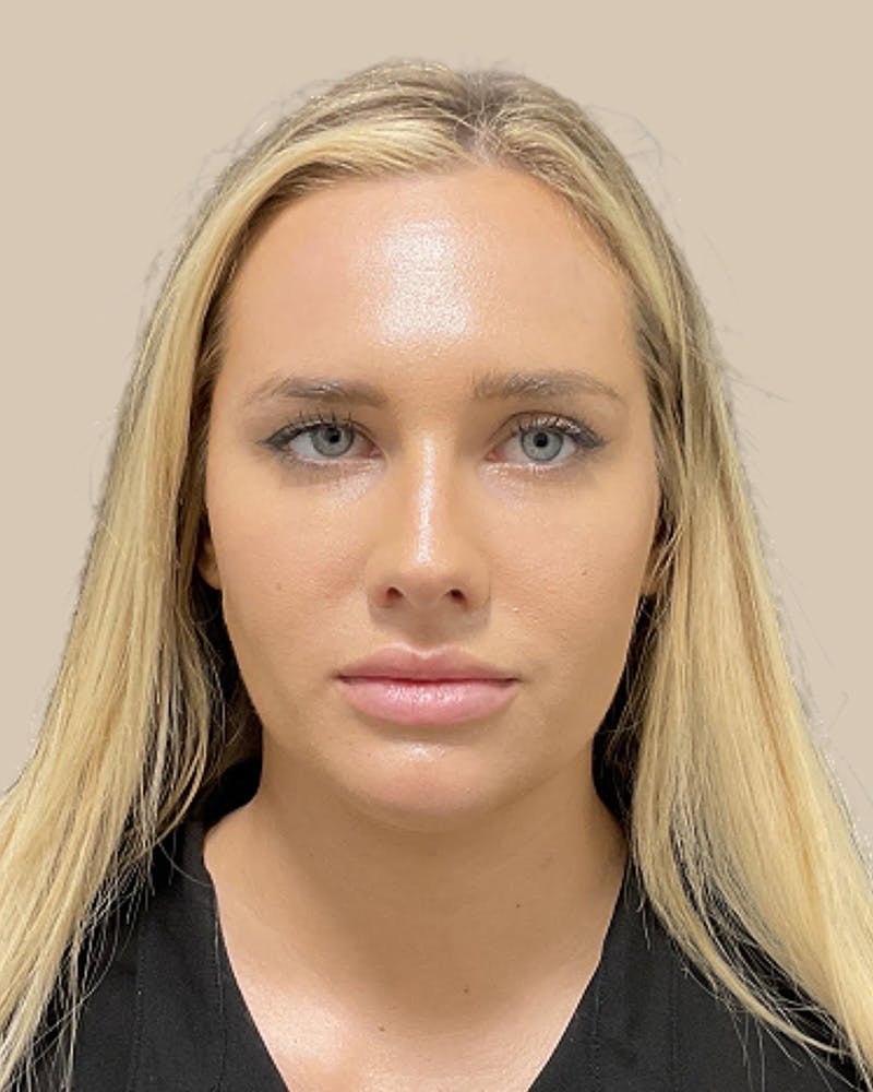Injectables Before & After Gallery - Patient 444551 - Image 1