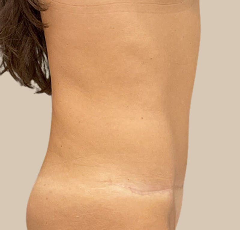 Tummy Tuck Before & After Gallery - Patient 319807 - Image 6