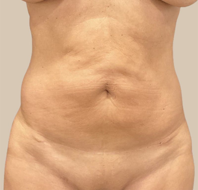 Tummy Tuck Before & After Gallery - Patient 319807 - Image 1