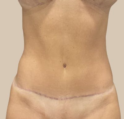 Tummy Tuck Before & After Gallery - Patient 319807 - Image 2