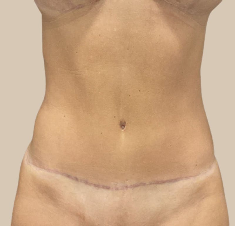 Tummy Tuck Before & After Gallery - Patient 319807 - Image 2