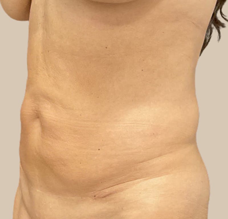 Tummy Tuck Before & After Gallery - Patient 319807 - Image 3