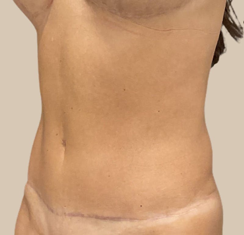 Tummy Tuck Before & After Gallery - Patient 319807 - Image 4