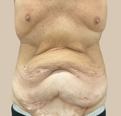 Tummy Tuck Before & After Gallery - Patient 364771 - Image 1
