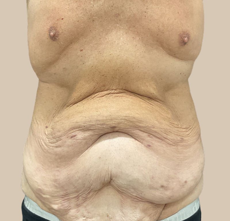 Top Surgery Before & After Gallery - Patient 378970 - Image 1