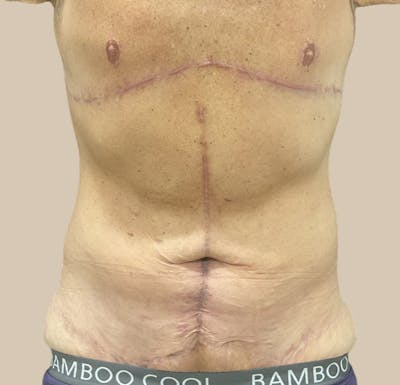 Tummy Tuck Before & After Gallery - Patient 364771 - Image 2
