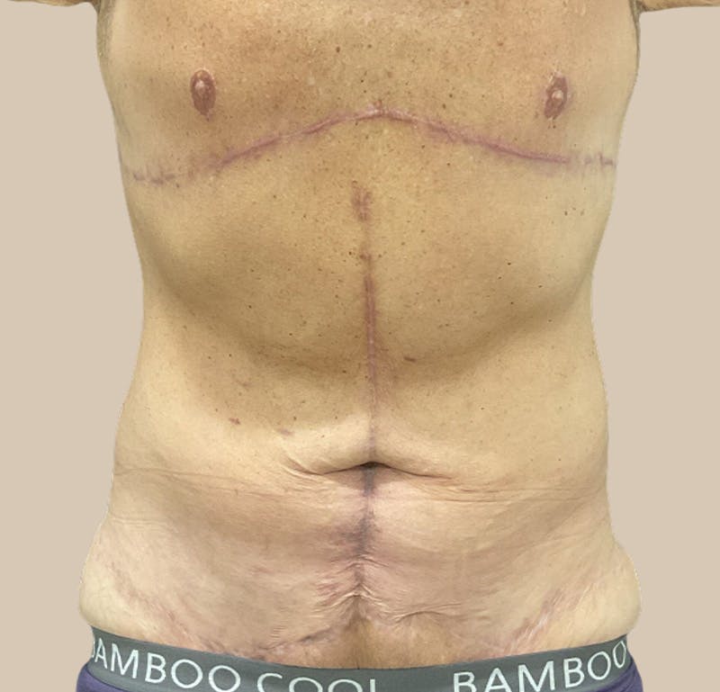 Top Surgery Before & After Gallery - Patient 378970 - Image 2