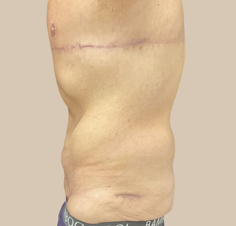 Top Surgery Before & After Gallery - Patient 378970 - Image 4