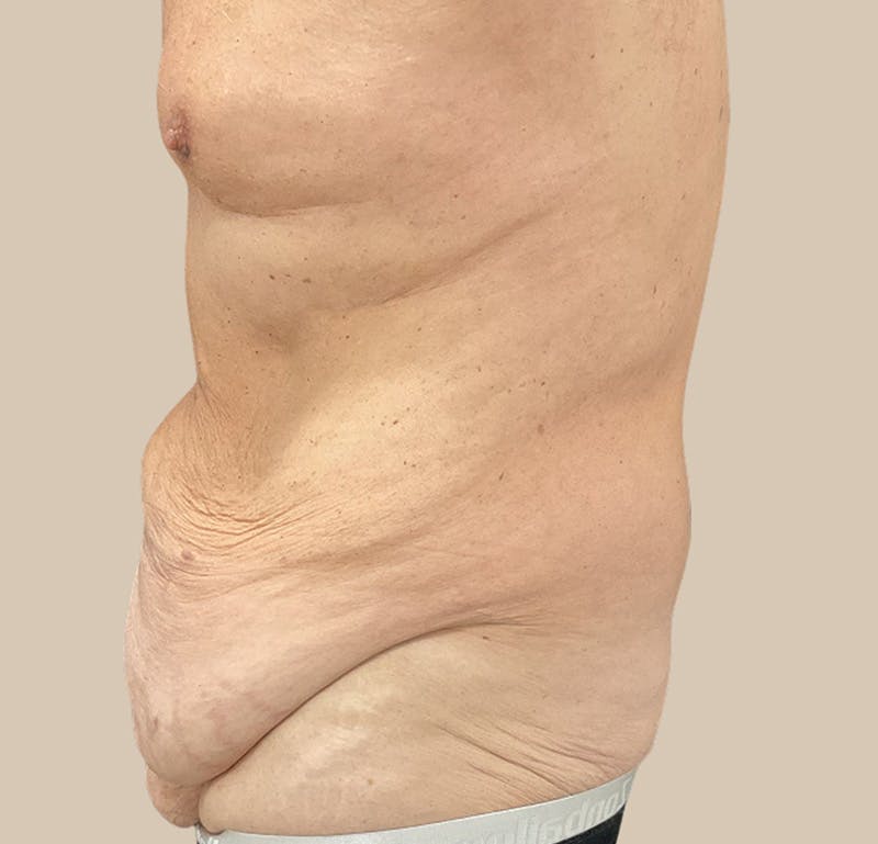 Top Surgery Before & After Gallery - Patient 378970 - Image 3
