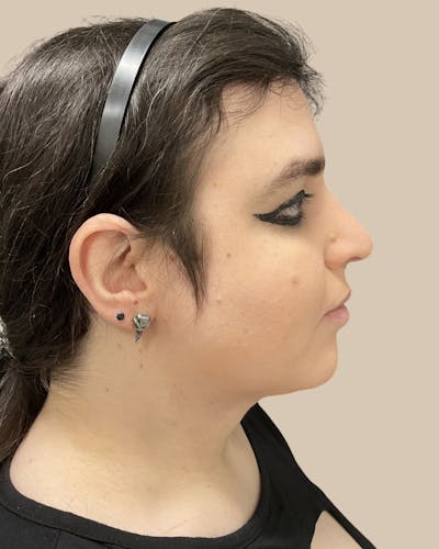 Rhinoplasty Before & After Gallery - Patient 265629 - Image 2