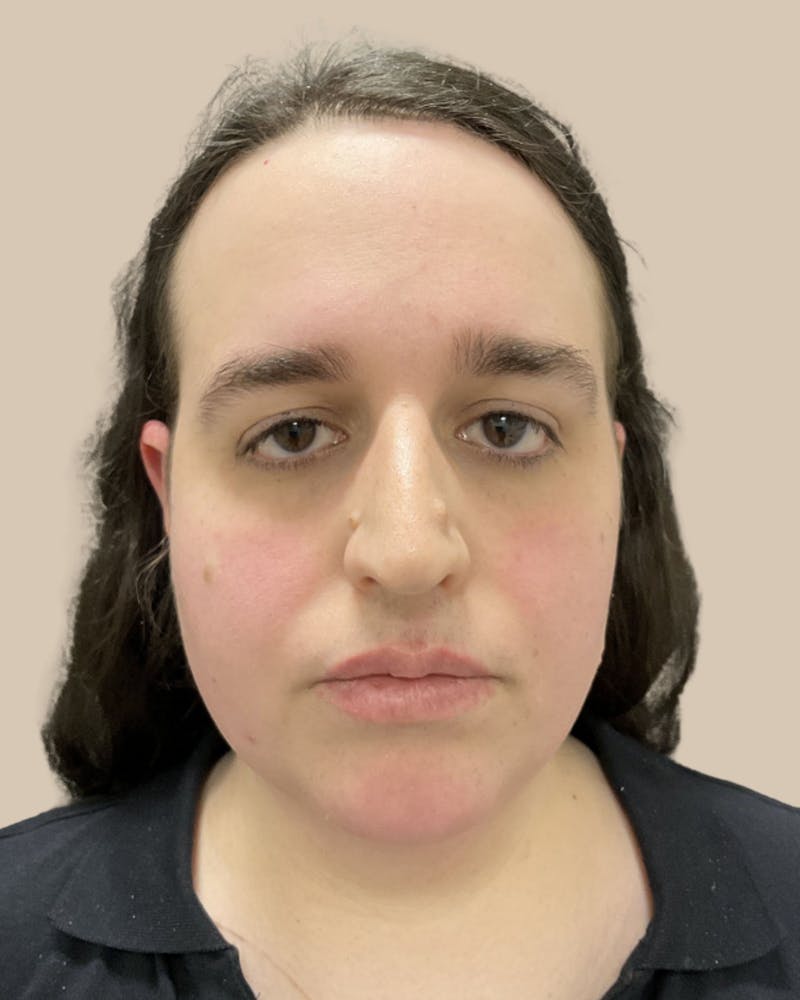 Forehead Reduction Before & After Gallery - Patient 198975 - Image 1