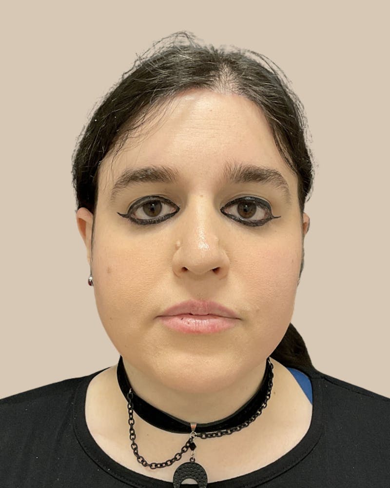 Forehead Reduction Before & After Gallery - Patient 198975 - Image 2