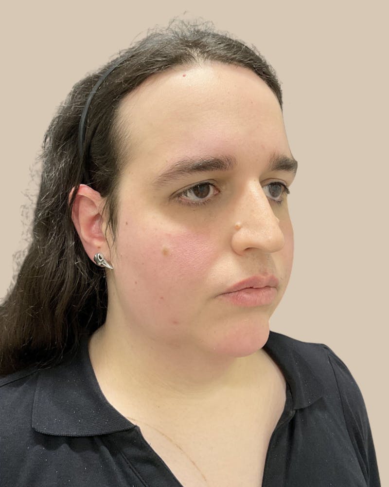 Forehead Reduction Before & After Gallery - Patient 198975 - Image 3