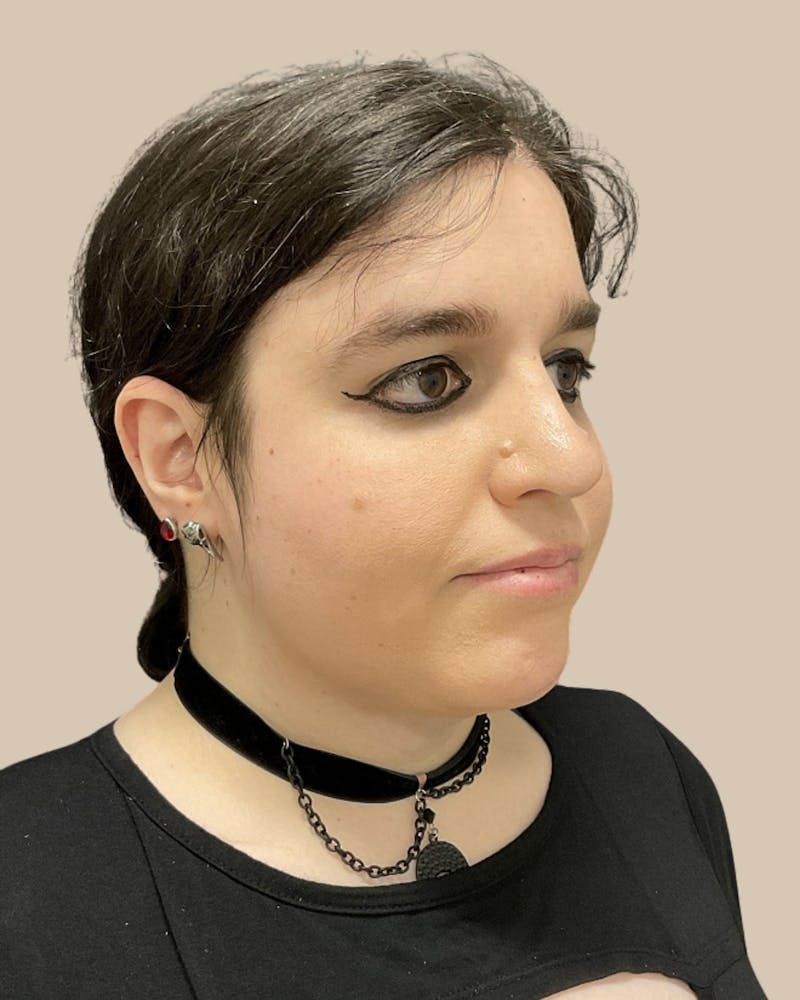 Forehead Reduction Before & After Gallery - Patient 198975 - Image 4