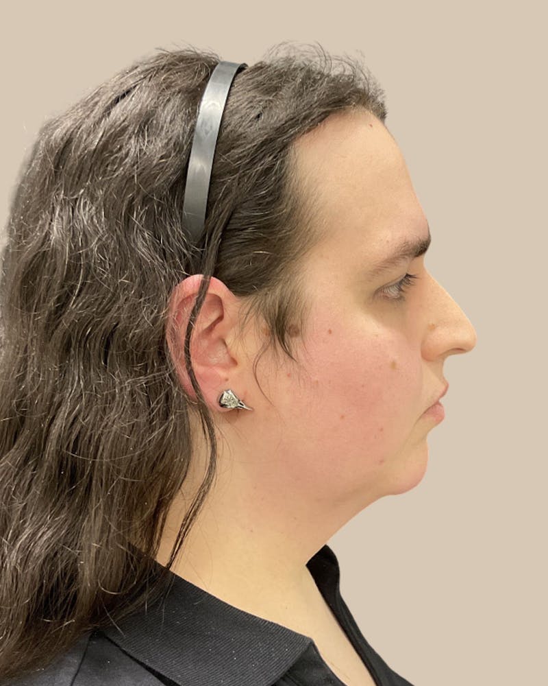 Forehead Reduction Before & After Gallery - Patient 198975 - Image 5