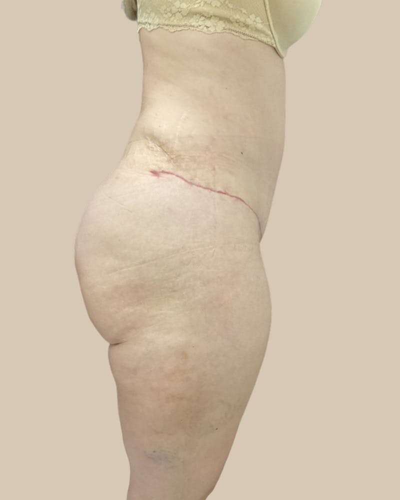 Tummy Tuck Before & After Gallery - Patient 252046 - Image 4