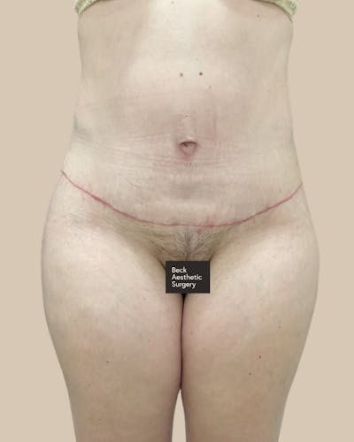 Liposuction Before & After Gallery - Patient 345836 - Image 2