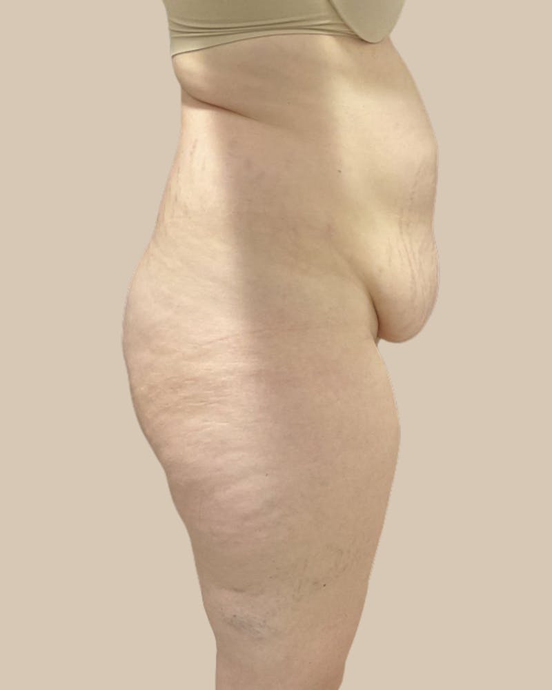 Tummy Tuck Before & After Gallery - Patient 252046 - Image 3