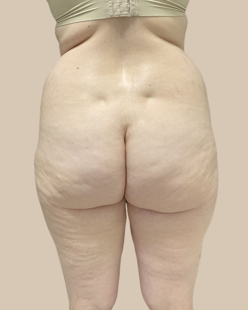 Tummy Tuck Before & After Gallery - Patient 252046 - Image 5