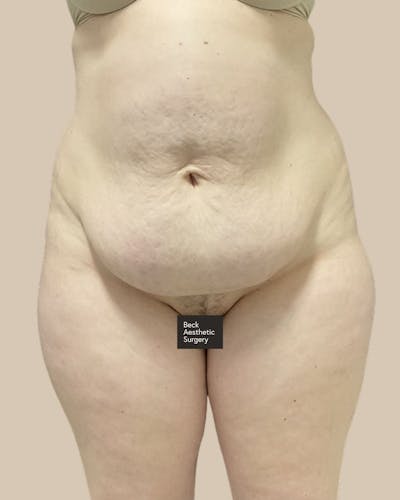 Liposuction Before & After Gallery - Patient 345836 - Image 1