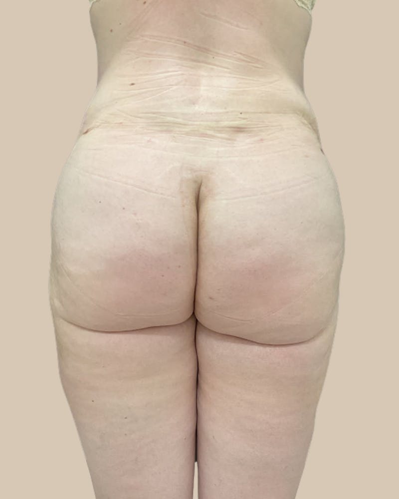 Tummy Tuck Before & After Gallery - Patient 252046 - Image 6