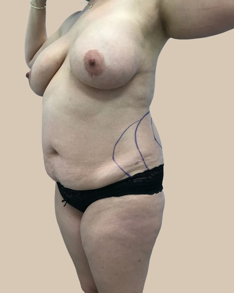 Brazilian Butt Lift Before & After Gallery - Patient 244390 - Image 7