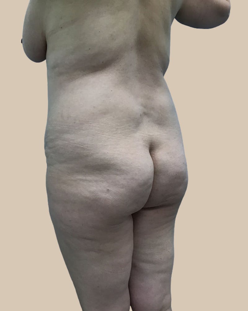 Brazilian Butt Lift Before & After Gallery - Patient 244390 - Image 3