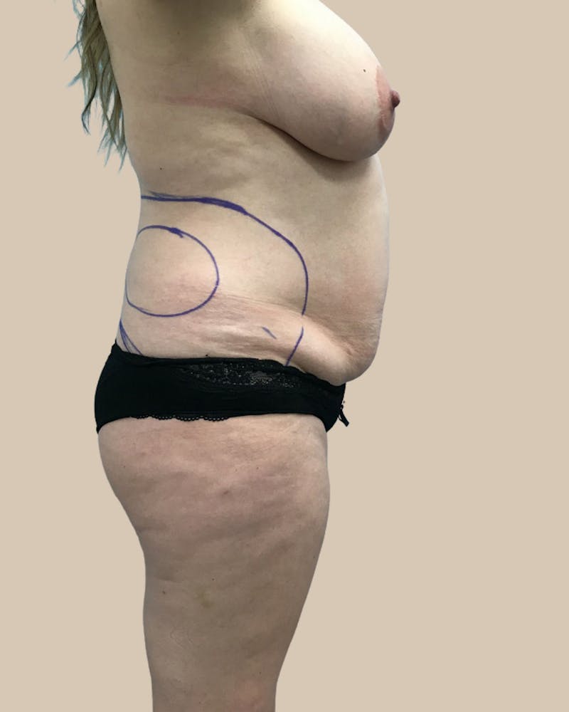 Brazilian Butt Lift Before & After Gallery - Patient 244390 - Image 5