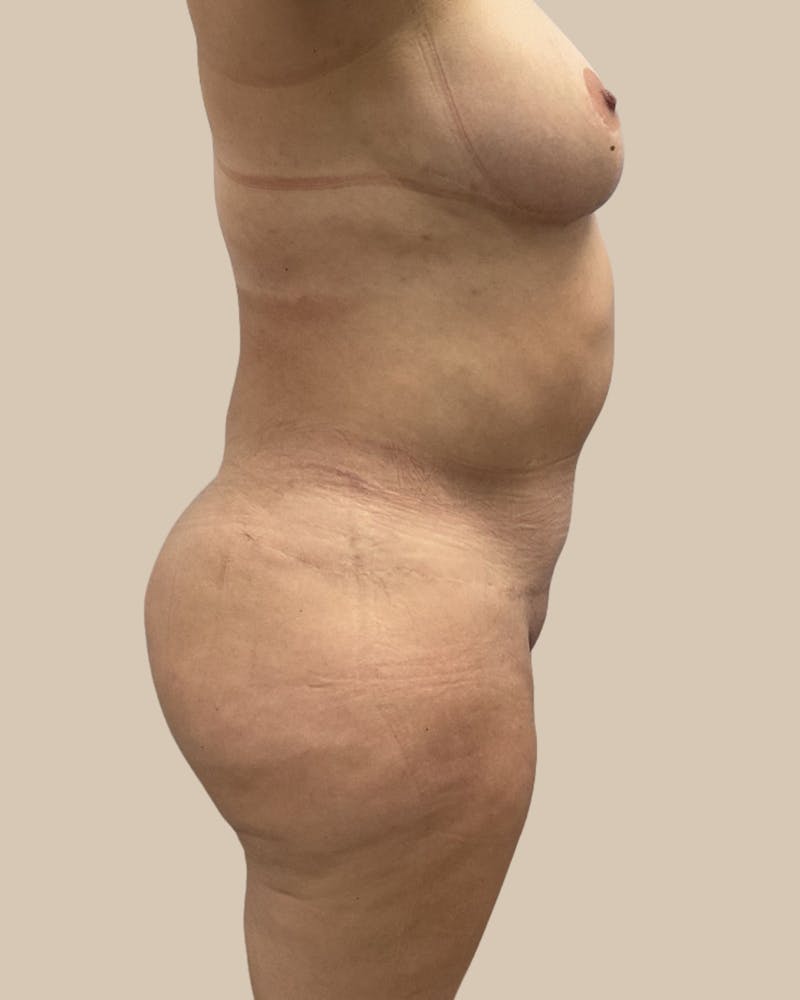 Brazilian Butt Lift Before & After Gallery - Patient 244390 - Image 6