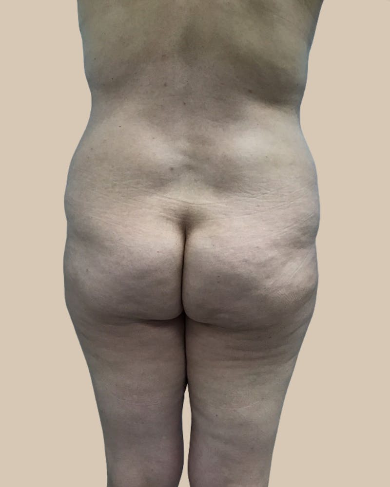 Brazilian Butt Lift Before & After Gallery - Patient 244390 - Image 1