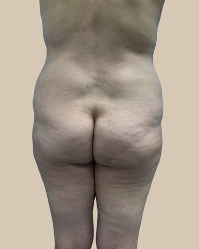 Brazilian Butt Lift Before & After Gallery - Patient 244390 - Image 1