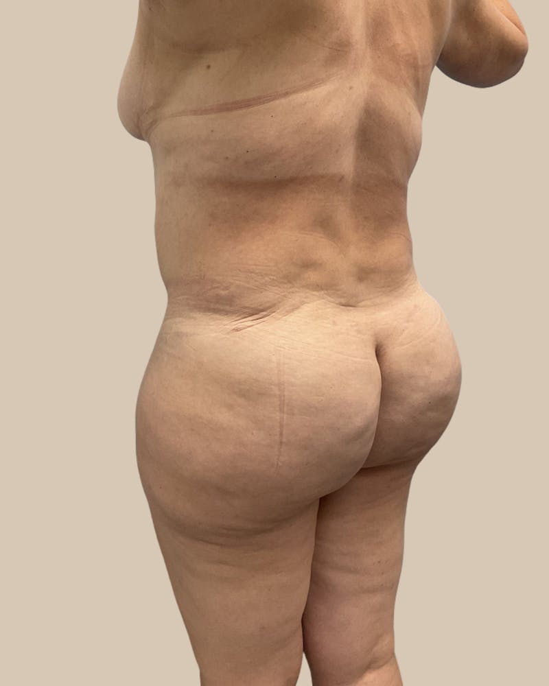 Brazilian Butt Lift Before & After Gallery - Patient 244390 - Image 4