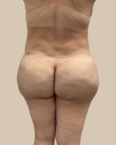 Brazilian Butt Lift Before & After Gallery - Patient 244390 - Image 2