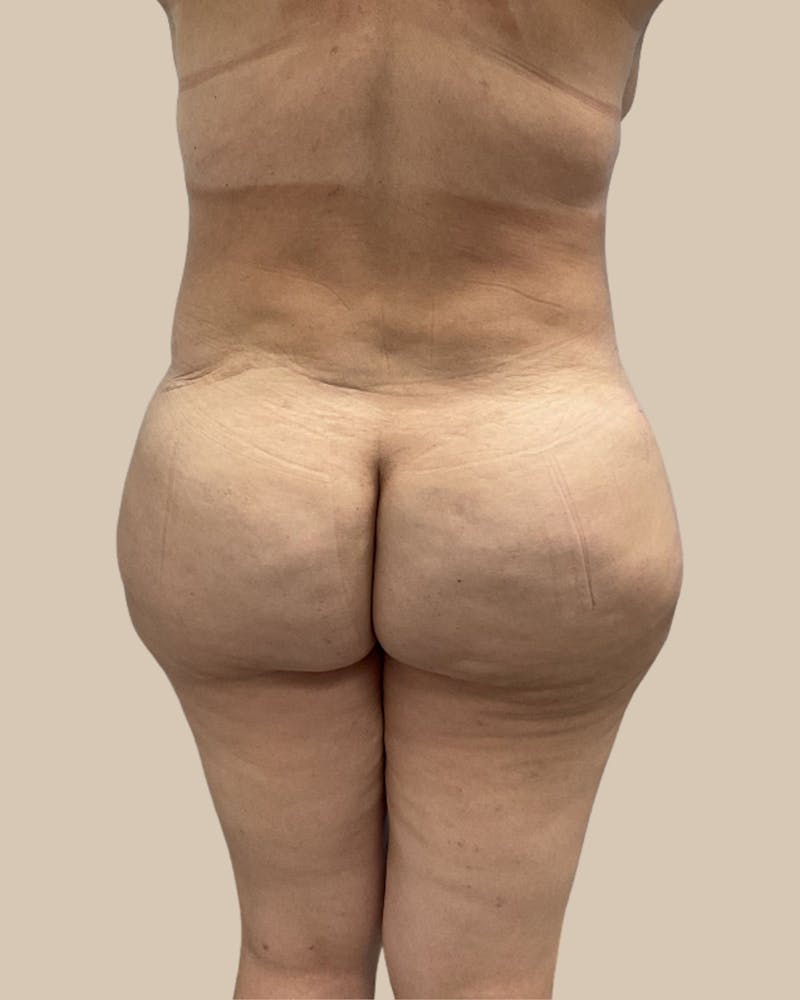 Brazilian Butt Lift Before & After Gallery - Patient 244390 - Image 2