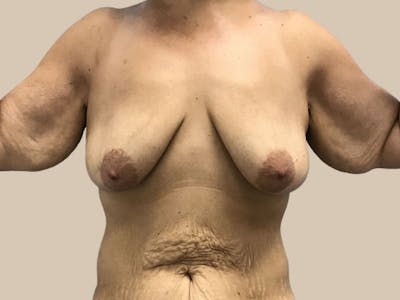 Breast Augmentation Before & After Gallery - Patient 331218 - Image 1