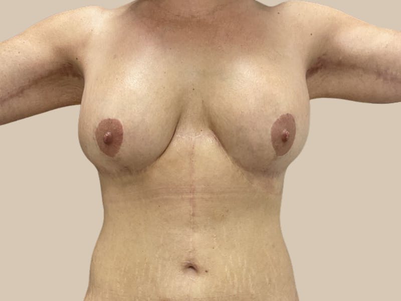 Breast Augmentation Before & After Gallery - Patient 331218 - Image 2