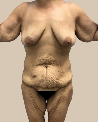 Thigh Lift Before & After Gallery - Patient 804205 - Image 1