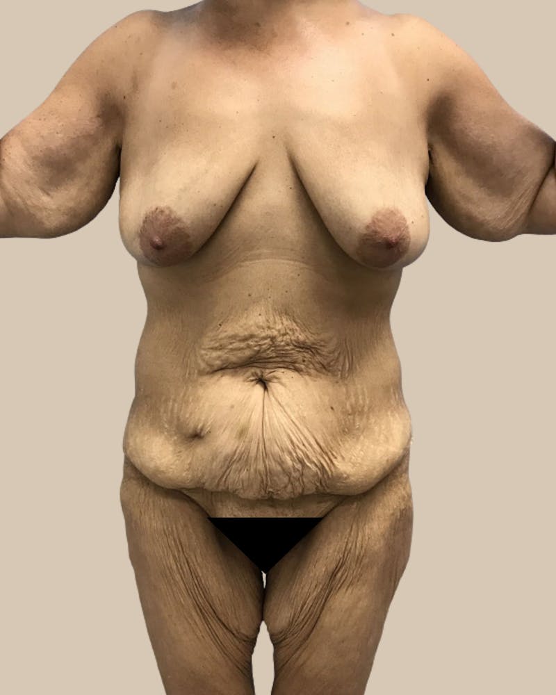 Thigh Lift Before & After Gallery - Patient 804205 - Image 1