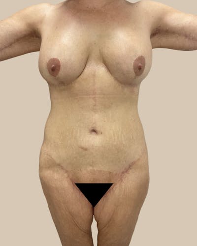 Thigh Lift Before & After Gallery - Patient 804205 - Image 2