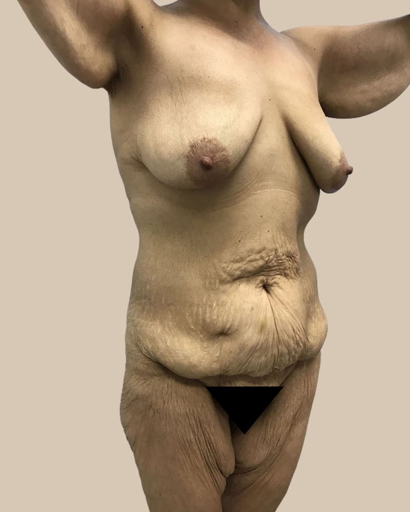 Thigh Lift Before & After Gallery - Patient 804205 - Image 3