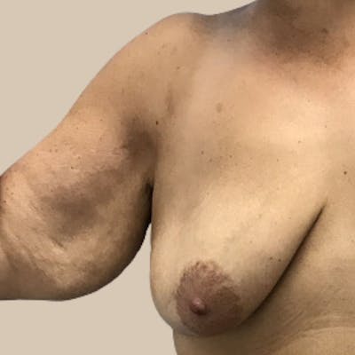 Brachioplasty Before & After Gallery - Patient 126051 - Image 1