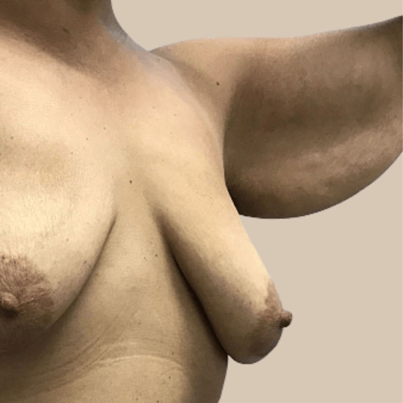 Brachioplasty Before & After Gallery - Patient 126051 - Image 5