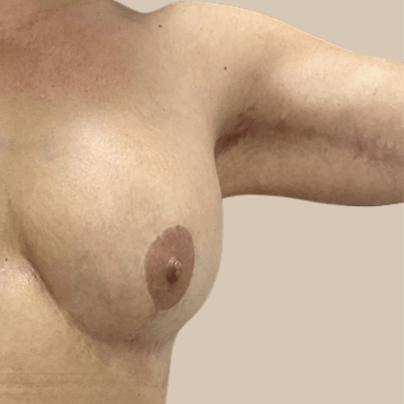 Brachioplasty Before & After Gallery - Patient 126051 - Image 4