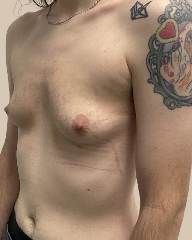 Top Surgery Before & After Gallery - Patient 116729 - Image 3