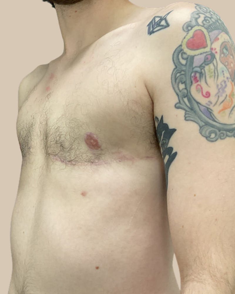 Top Surgery Before & After Gallery - Patient 116729 - Image 4